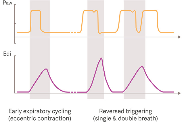 Clinical illustration comparing early expiratory cycling wave forms with reversed triggering wave forms