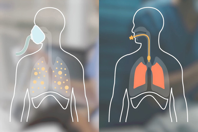 Graphic illustration showing both obstructive COPD non-invasive patient with mask and restrictive ARDS intubated patient